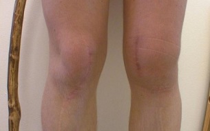 etapy rozwoju artrozy kolana