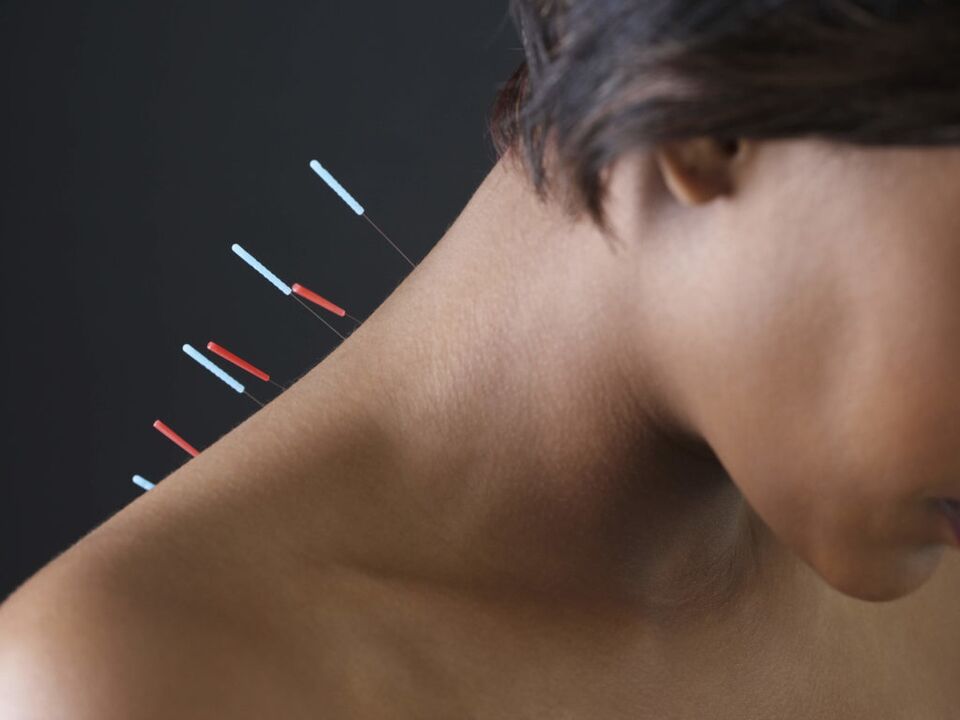 Akupunktura na osteochondrozę szyjną eliminuje procesy zapalne