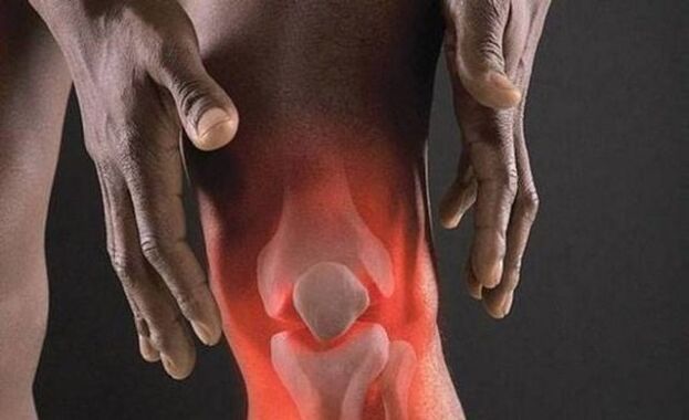 Artrozie towarzyszy proces zapalny w stawie kolanowym